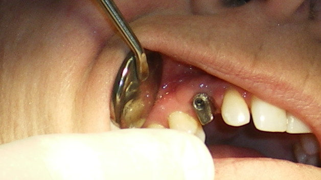 http://dentalimplantscost.us/wp-content/uploads/2013/07/CustomAbutment-628x353.jpg