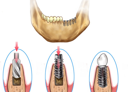 http://dentalimplantscost.us/wp-content/uploads/2013/07/Implant-placement-sequence-into-jaw1-489x353.jpg