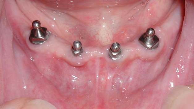 http://dentalimplantscost.us/wp-content/uploads/2013/07/PA161989-628x353.jpg