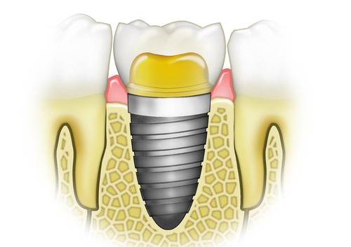https://dentalimplantscost.us/wp-content/uploads/2013/07/Implant-crown-adjacent-teeth-drawing-500x353.jpg